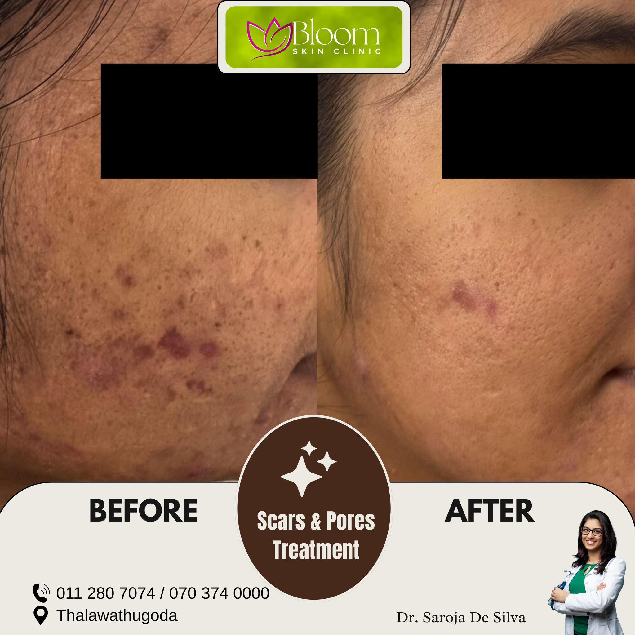 Bloom Skin Clinic Facebook ad: Transform Your Skin with CO2 Fractional Laser!