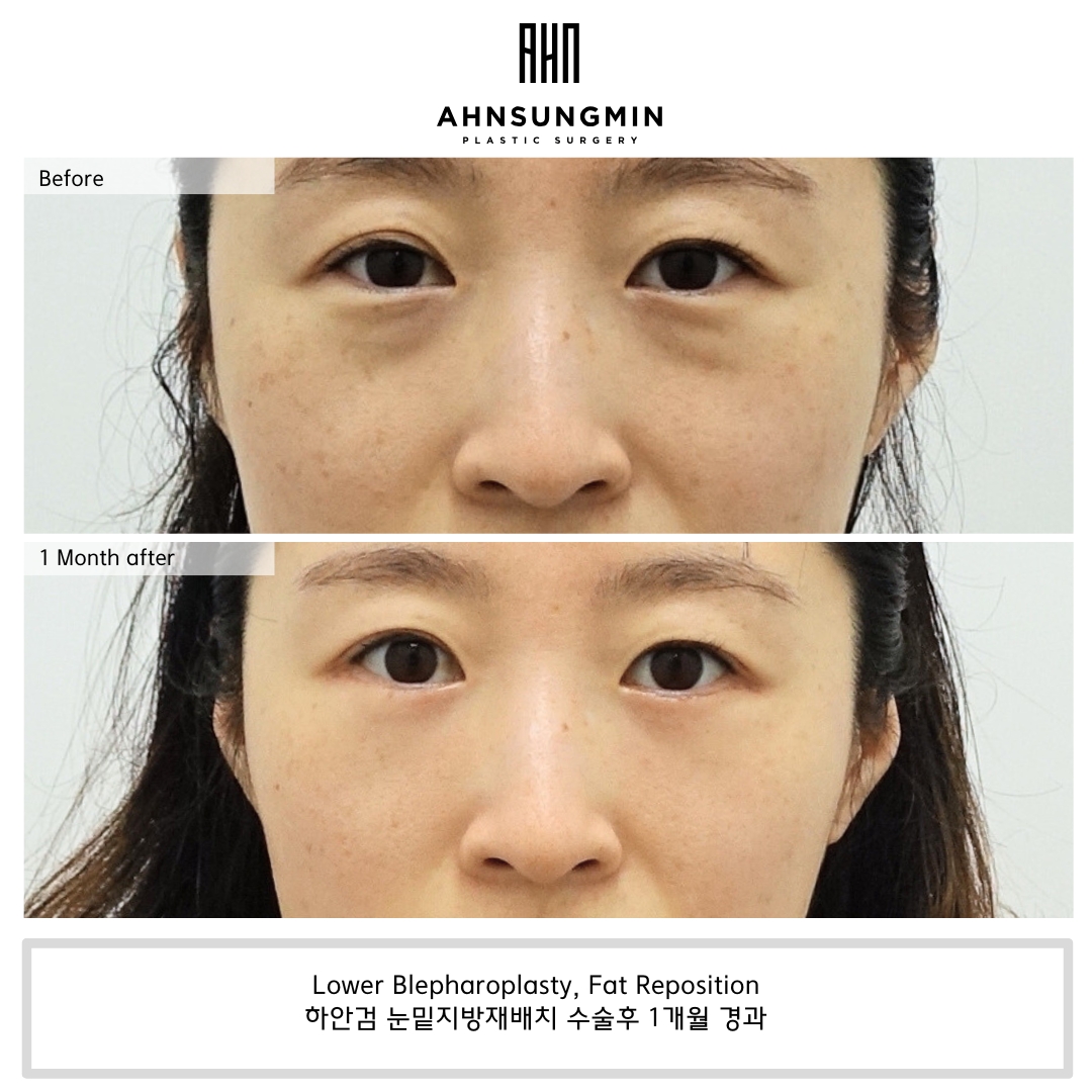 Ahn Sung Min Plastic Surgery Facebook ad: Say goodbye to under-eye bags and hello to…