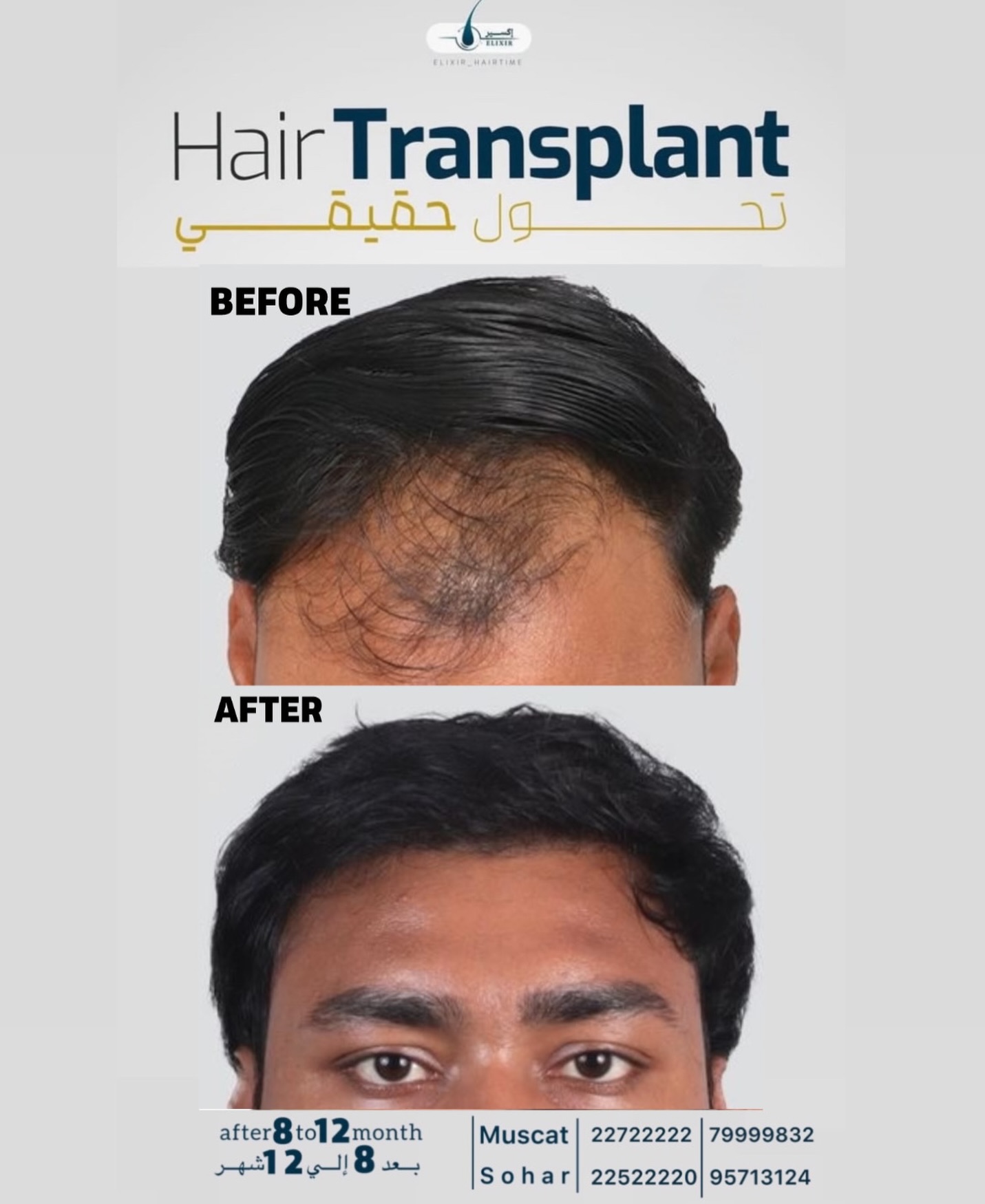 Elixir Hair Time Facebook ad: زراعة الشعر ما تعید الشعر بس.تعید لك مظهرك…
