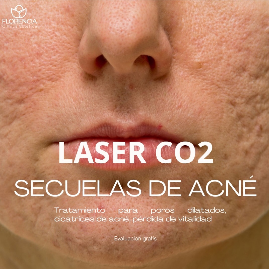 clinicaesteticaflorencia Facebook ad: ¿Conoces el poder del LÁSER CO2 para tratar…