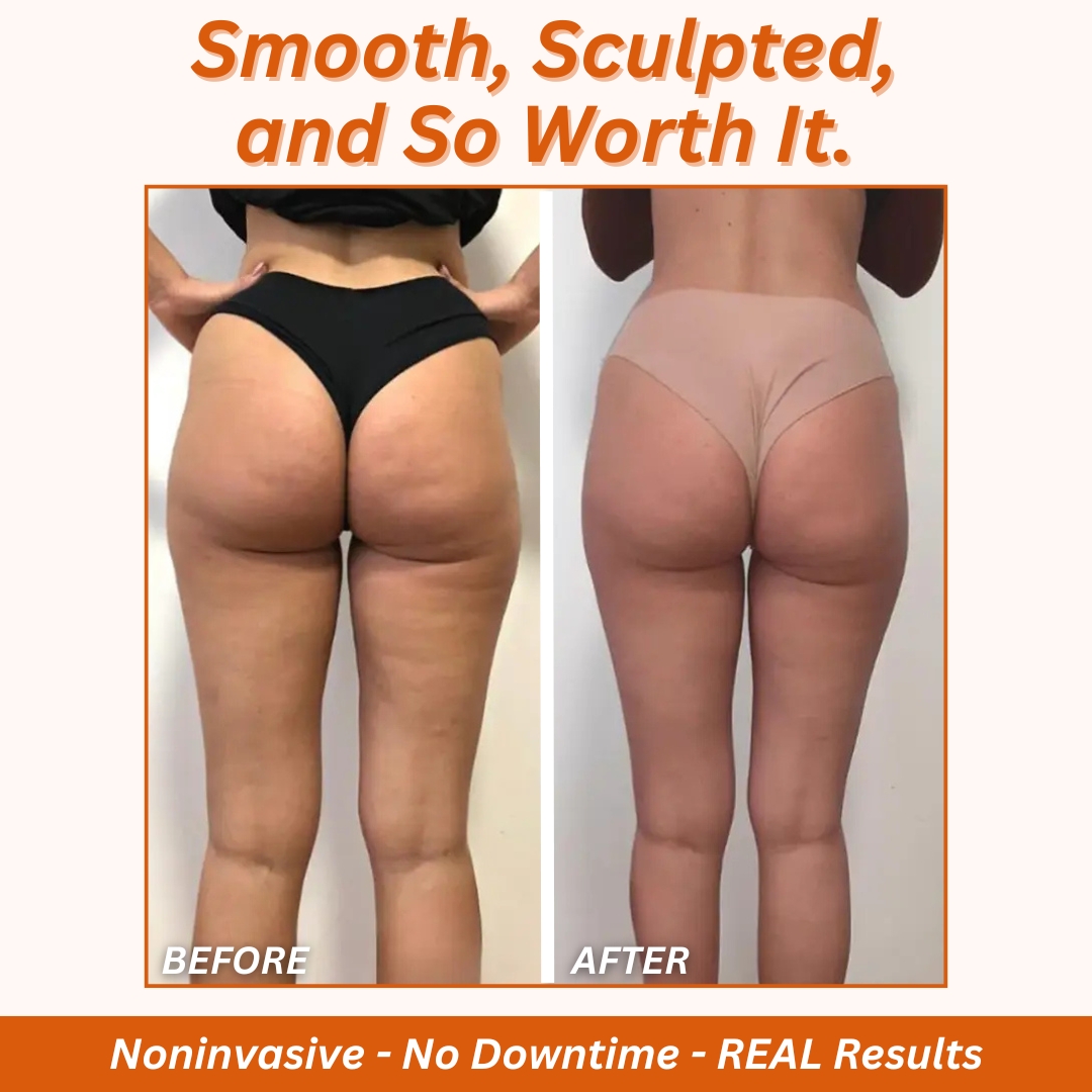 iCRYO Stuart Facebook ad: Bye-Bye Cellulite Treatment NOW $199