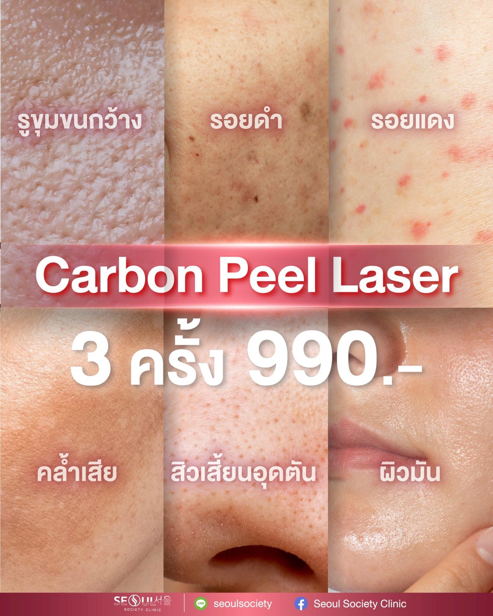 Seoul Society Clinic สาขาเซ็นทรัล เวสต์เกต Facebook ad: ผิวหมอง ผิวมัน สิวอุดตัน รูขุมขนกว้าง รอยสิวเยอะ