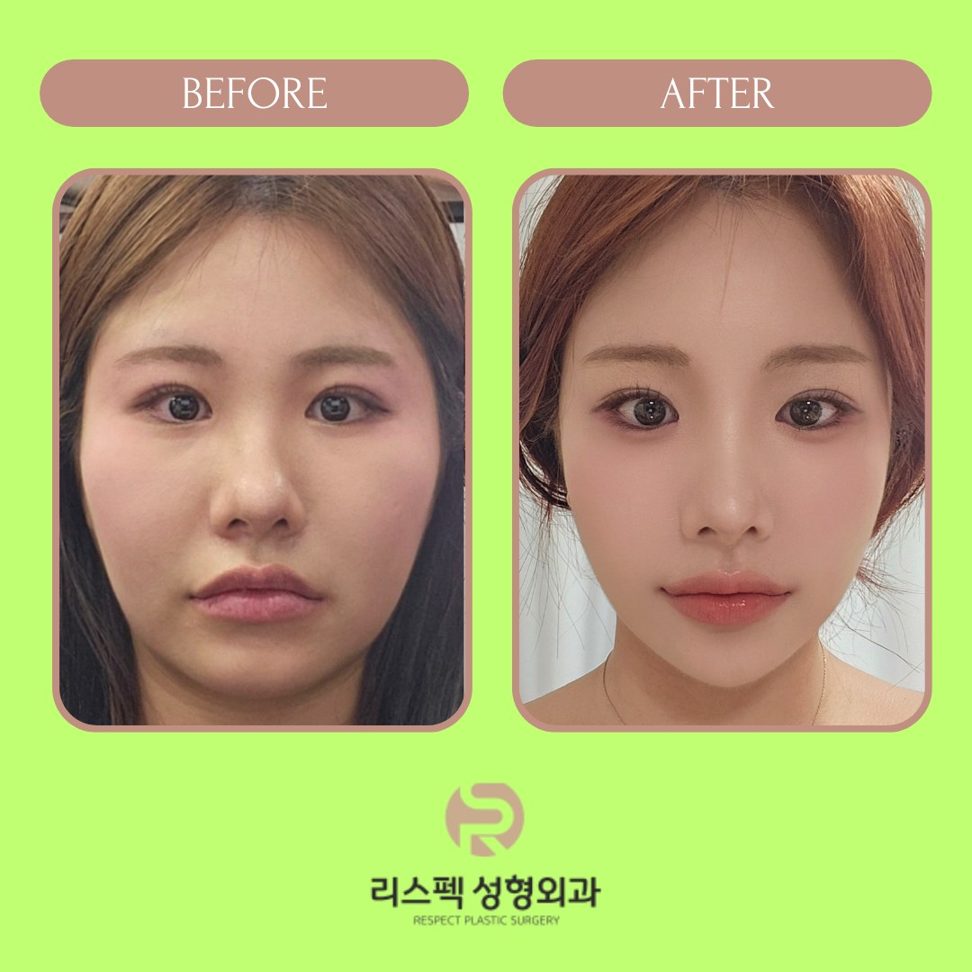 Respect Plastic Surgery - 리스펙 성형외과 Facebook ad: Cheekbone Reduction & Ultherapy in Korea
