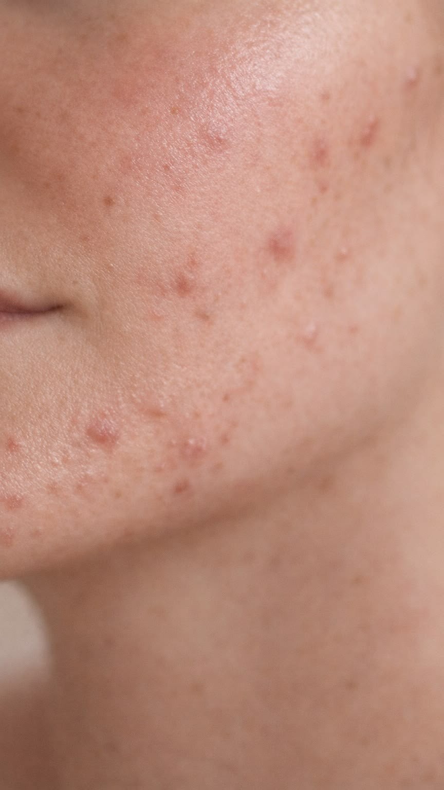 Skin and wellness Facebook ad: ACNÉ