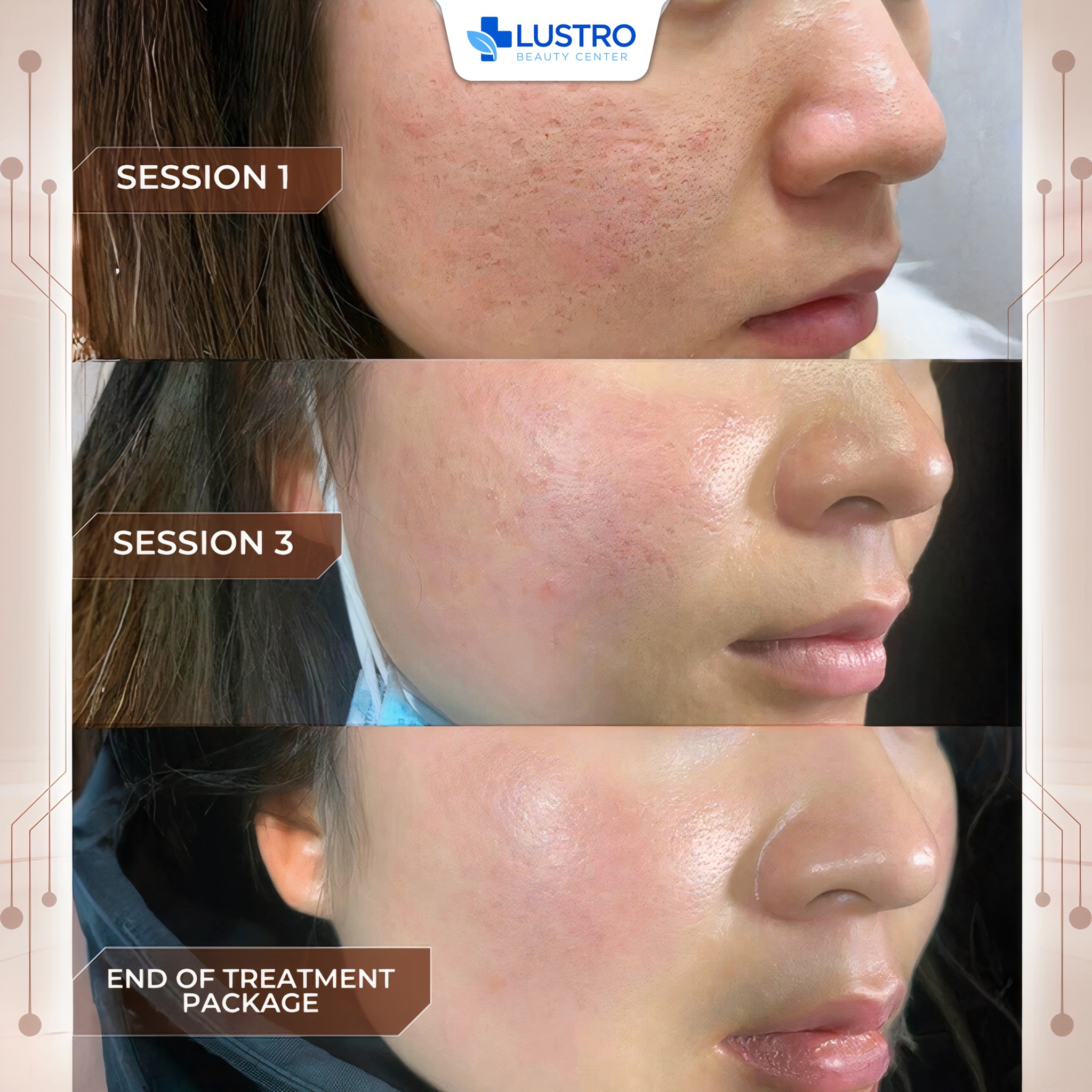 Lustro International Dermatology Center Facebook ad: ADVANCED SCAR REVISION, SMOOTH SKIN AFTER THE TREATMENT