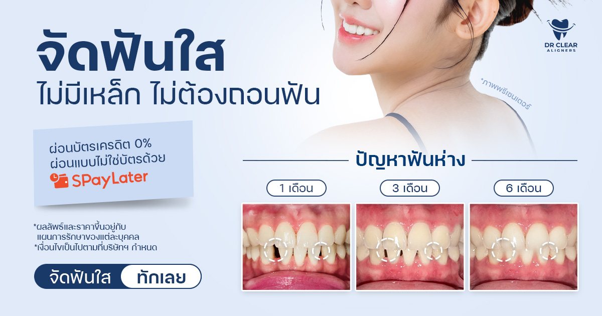 Dr Clear Aligners Thailand Facebook ad