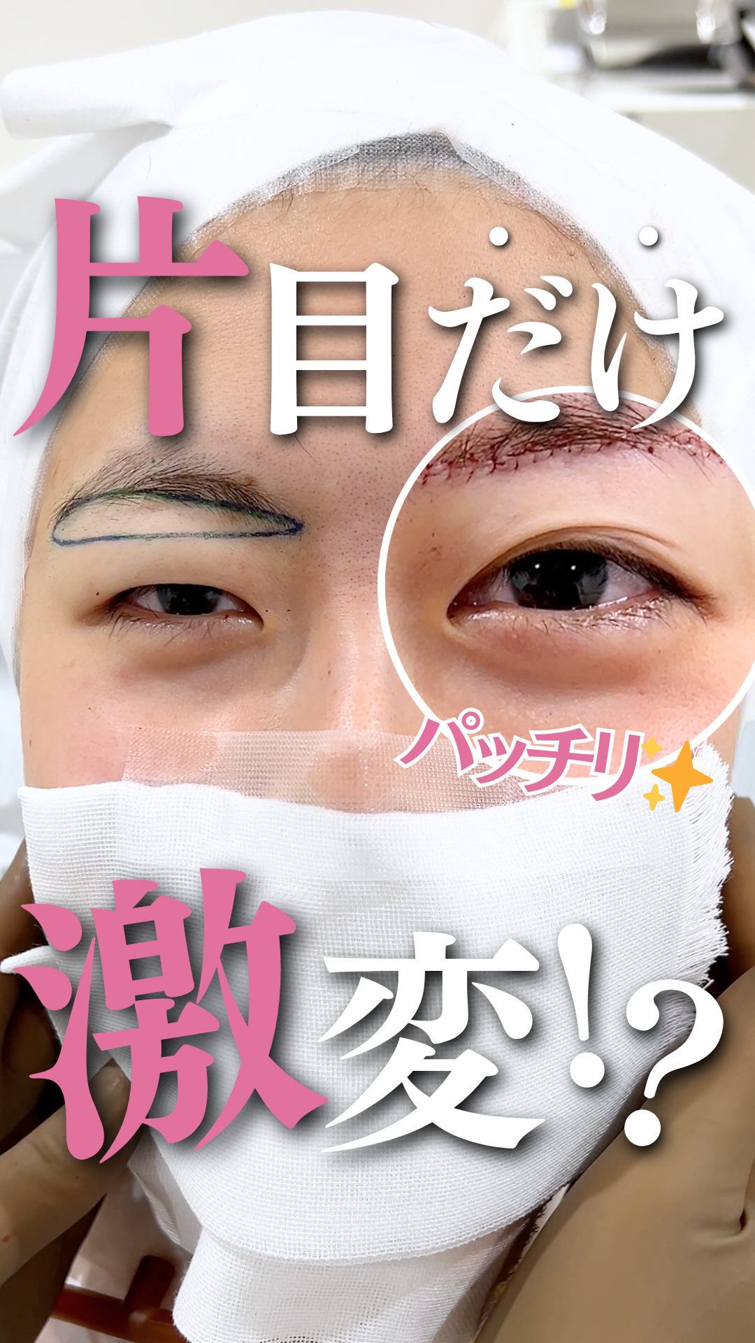 二重整形専門 酒井知子 Facebook ad: 片目だけでこの差!