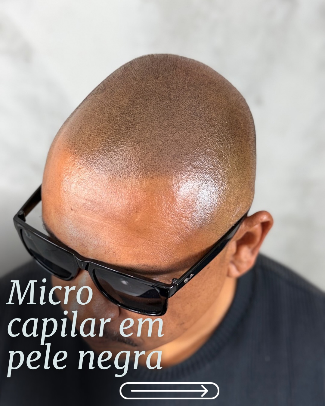 Geisa Silva - Micropigmentação Capilar Facebook ad: Micropigmentação capilar em pele negra