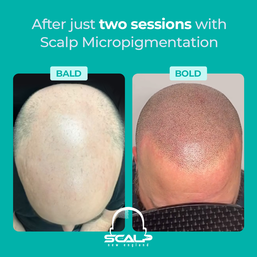 Scalp New England Facebook ad: Massachusetts, $250 Off Scalp Micropigmentation