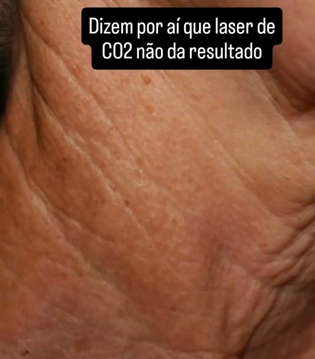 Dra. Milena Ribeiro Facebook ad: cicatriz de acne, rugas e manchas?