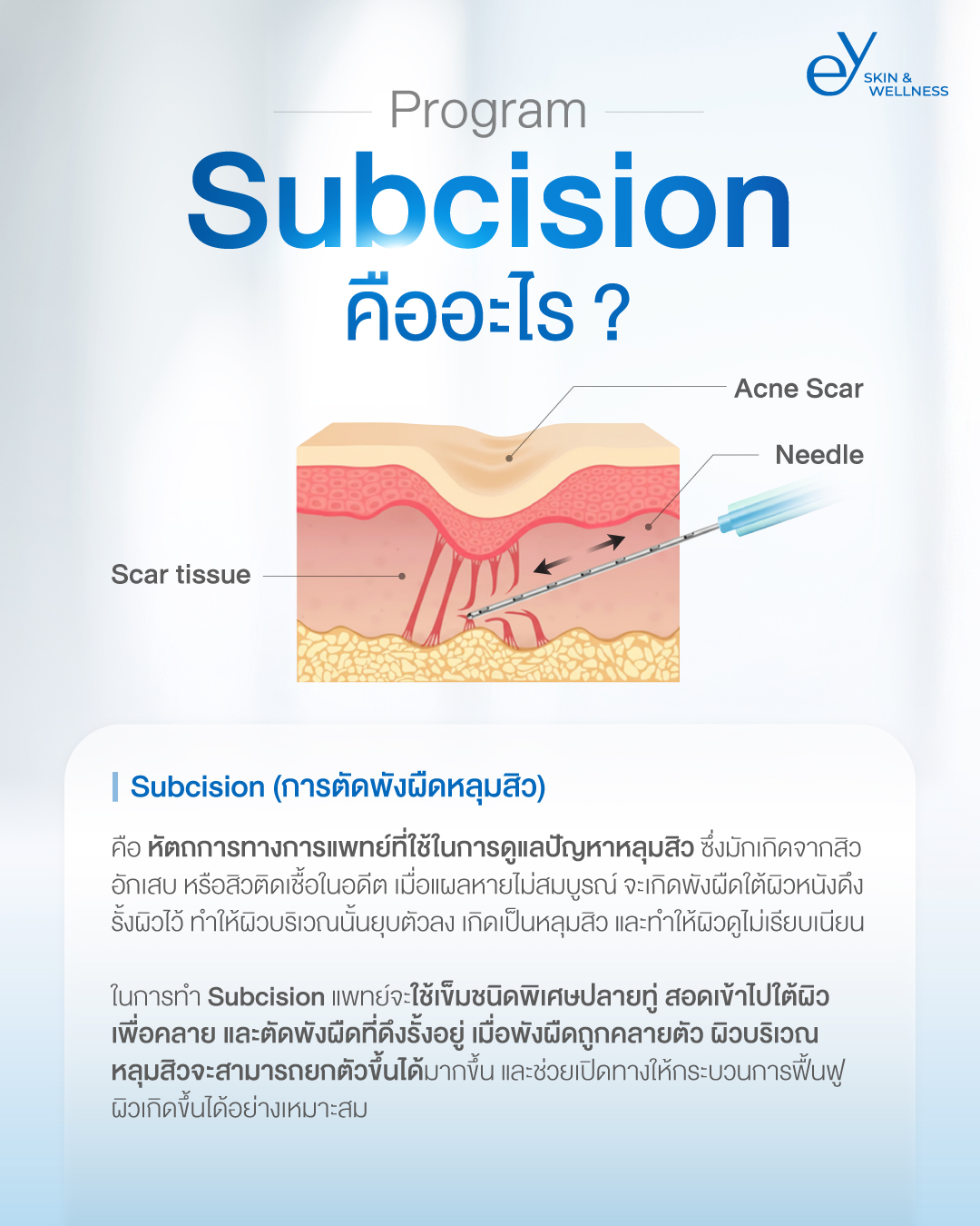 EY Clinic Facebook ad: การทำ Subcision คืออะไร?