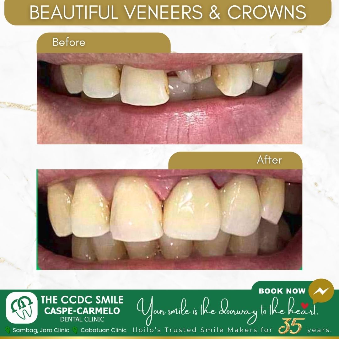 Caspe-Carmelo Dental Clinic / The CCDC Smile Facebook ad: Chat in Messenger
