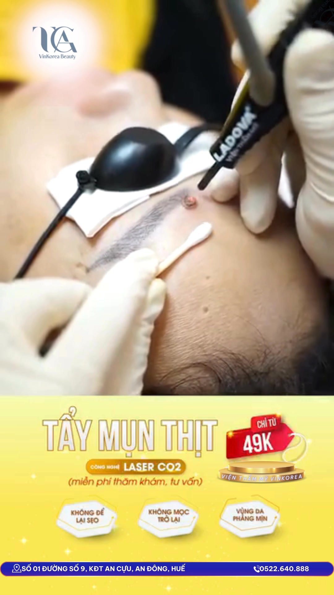 Tẩy Nốt Ruồi Facebook ad: TẨY MỤN THỊT, NỐT RUỒI KHÔNG SẸO BẰNG…