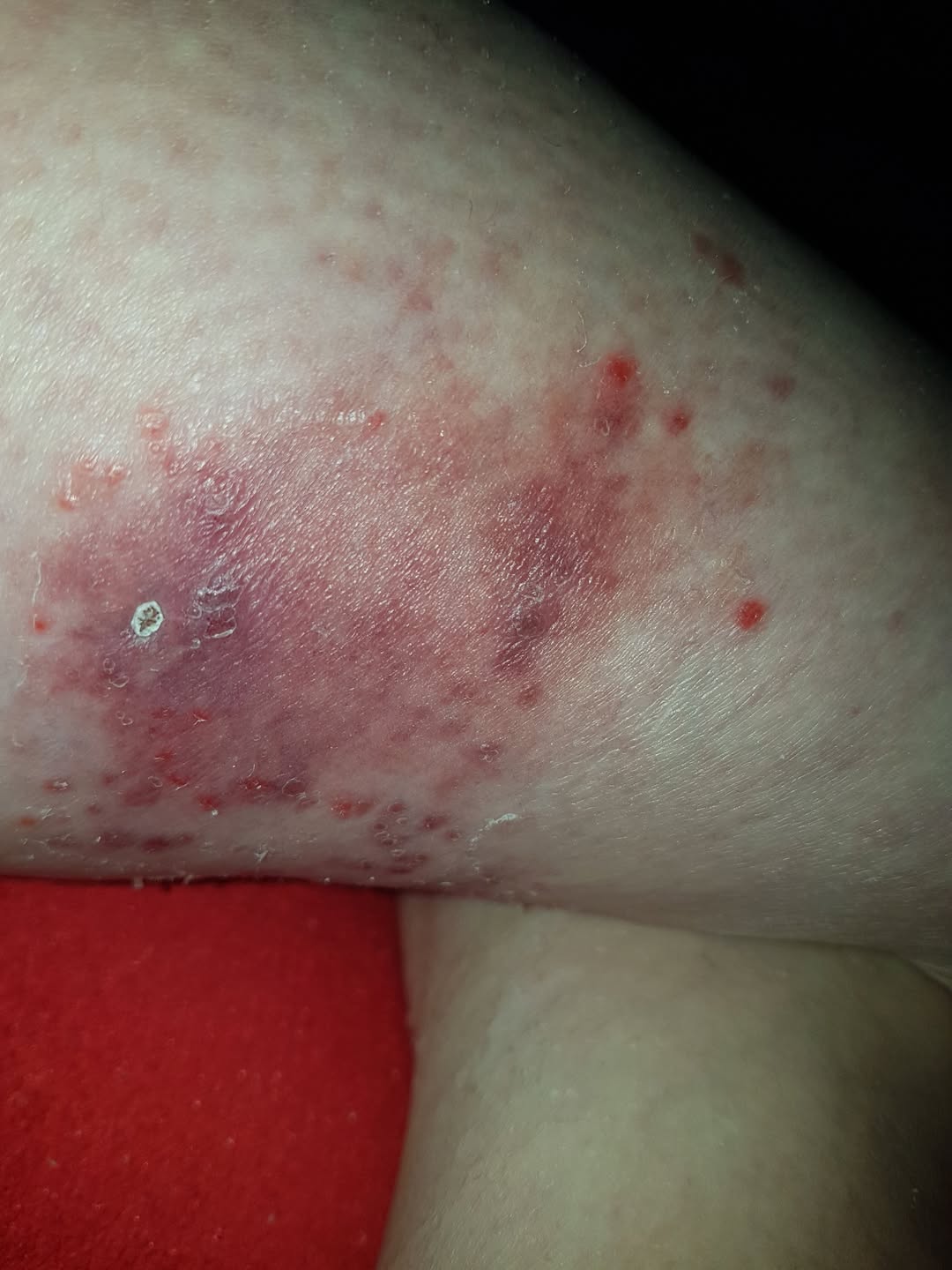 Nancy Millar Facebook ad: I spent $1,200 on steroid creams, antibiotics, and miracle…
