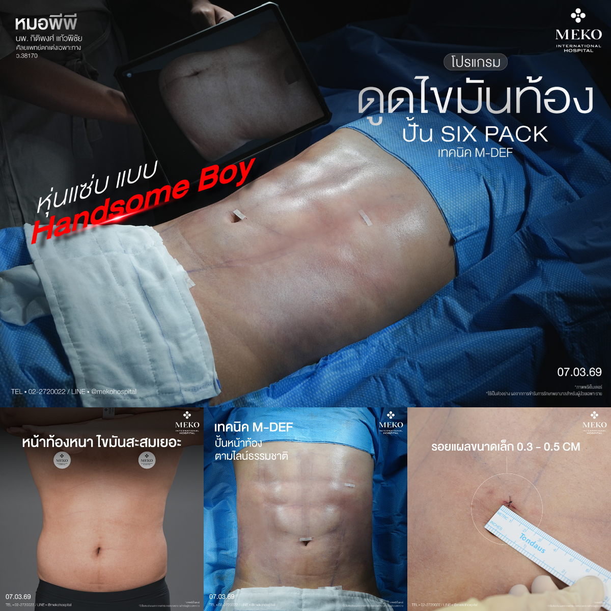 ดูดไขมัน ตัดหนังหน้าท้อง by Meko Hospital Facebook ad