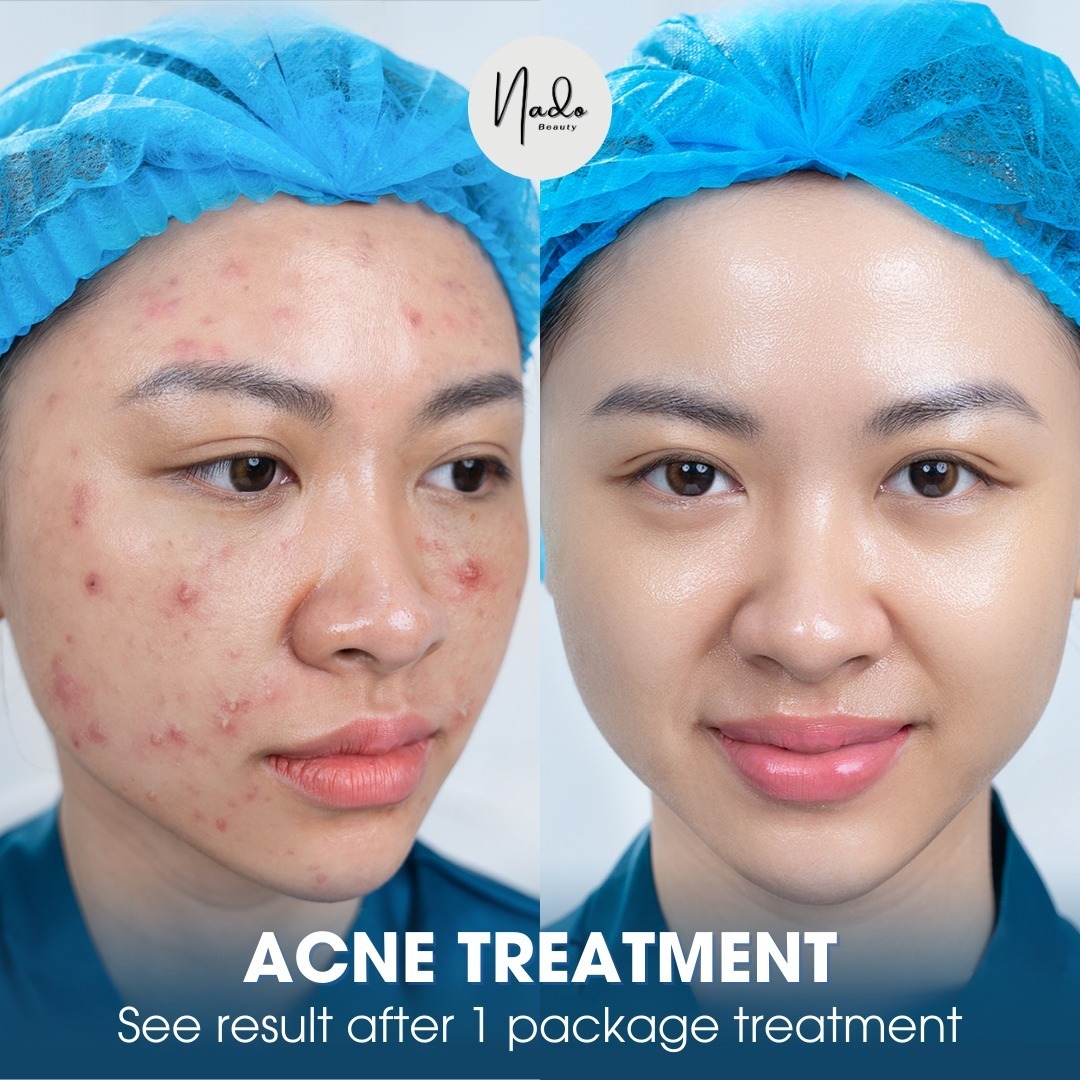 Nado Clinic Acne & Scar Treatment Davao Facebook ad