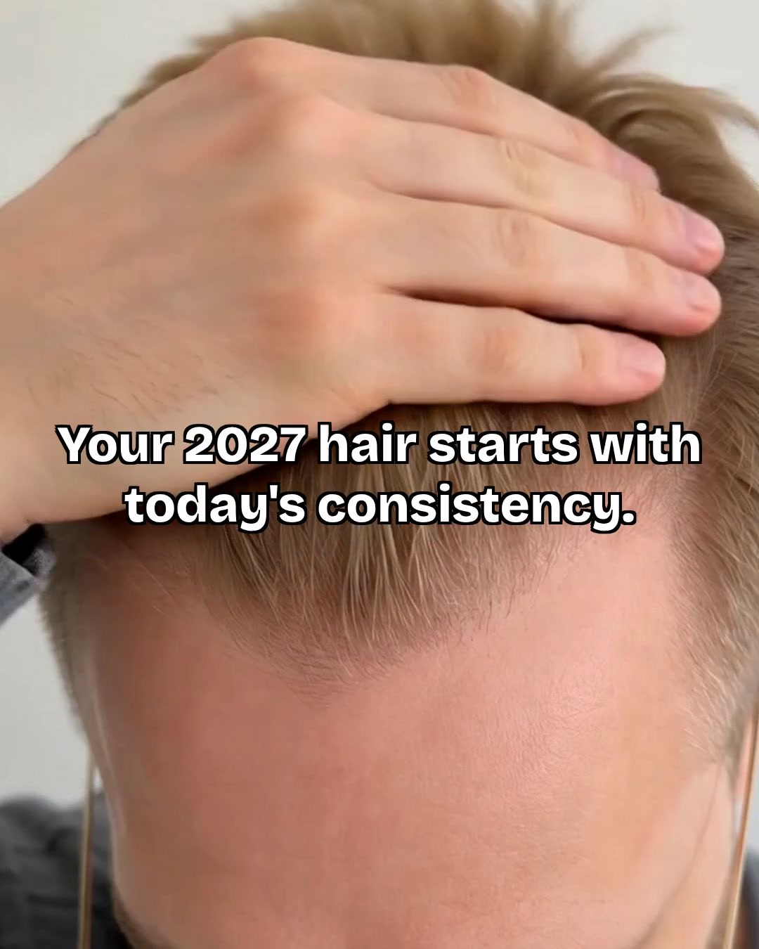 Scandinavian Biolabs Facebook ad: Next Year's Hairline Is Decided Now