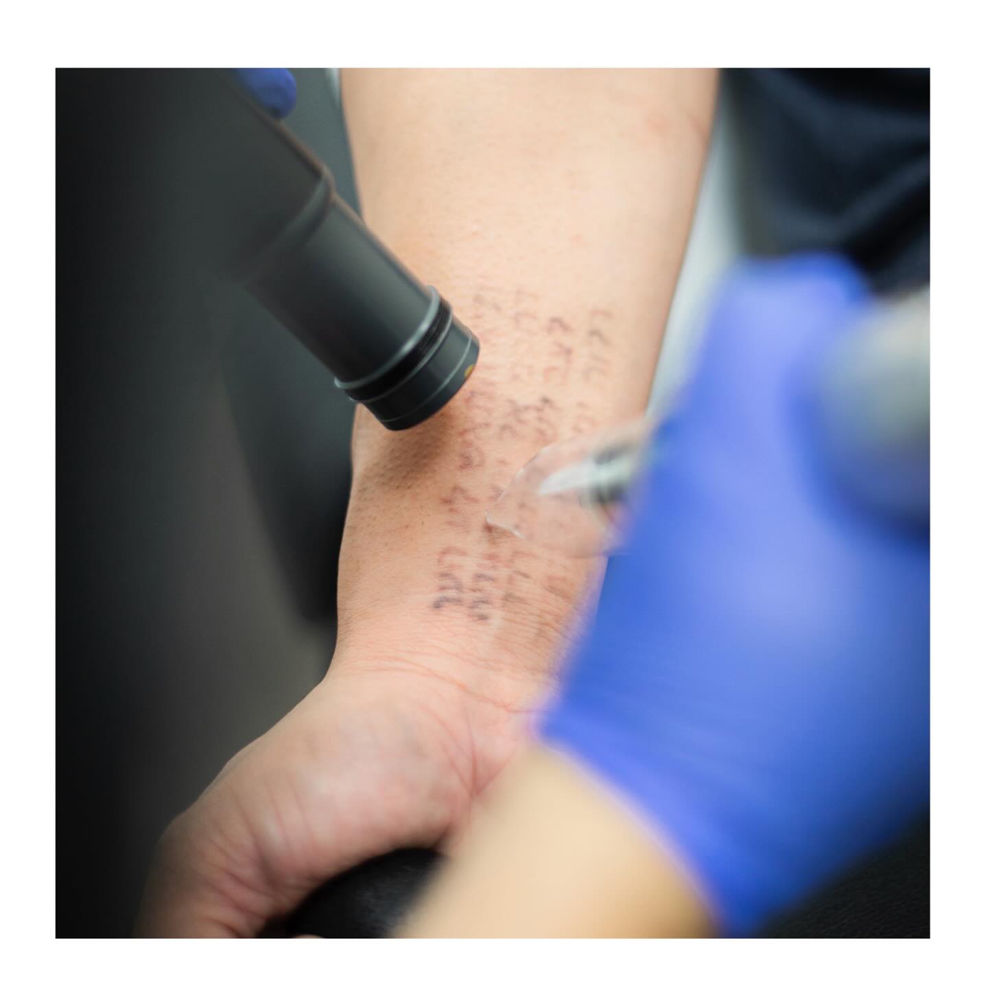 Progress MD Facebook ad: Considering Laser Hair or Tattoo Removal?