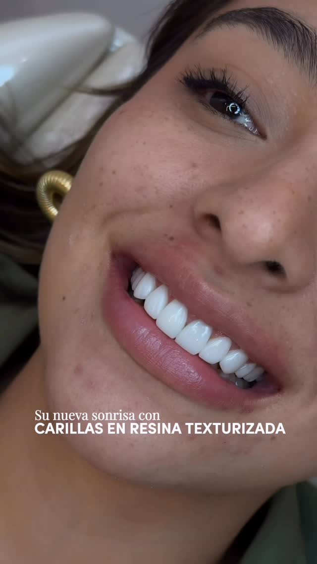 Sonrisa Perfecta Facebook ad: Diseño de sonrisa con carillas de resina texturizada