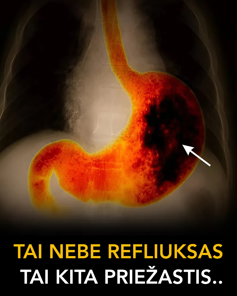Skrandžio ABC Facebook ad: Refliuksas: per mažas ar per didelis rūgštingumas?