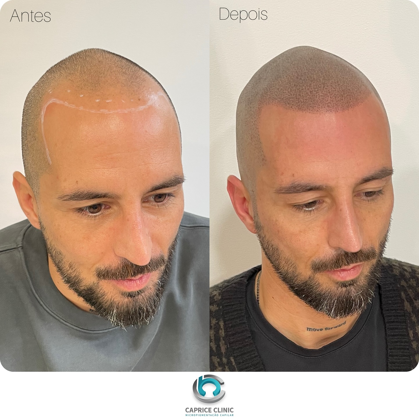 Caprice - Micropigmentação Capilar Facebook ad: Mais um incrível resultado com a marca da…