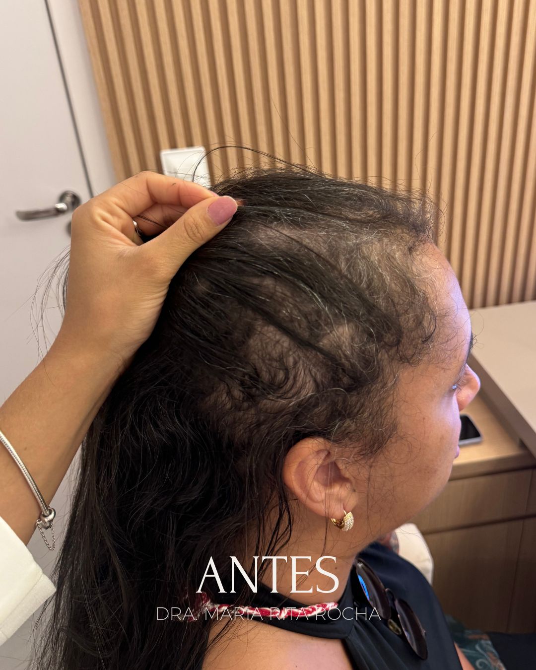 Dra. Maria Rita Facebook ad: Cansada de ver seu cabelo cair e perder…
