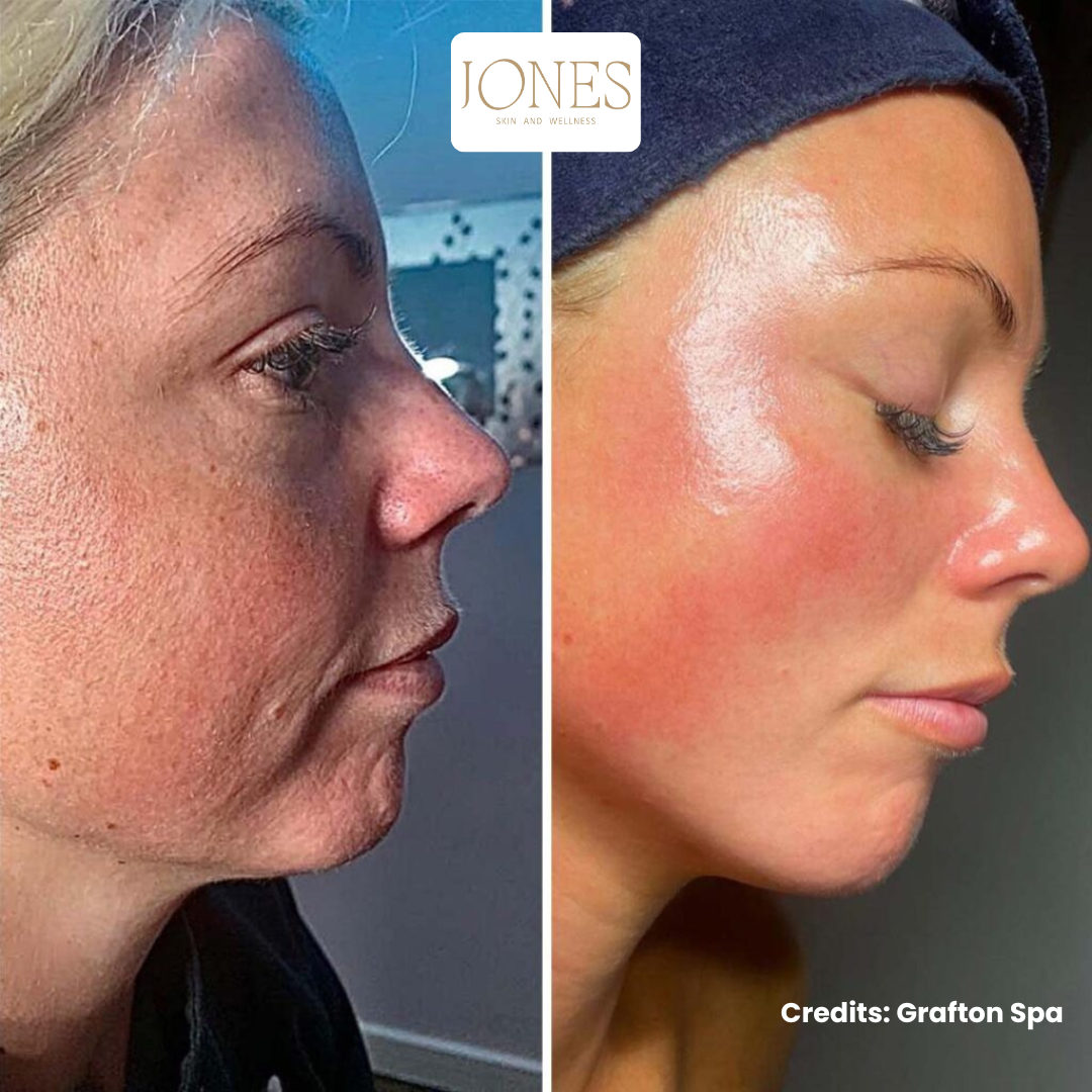 Carrie Jones Medical Aesthetics Facebook ad: Get Neck FREE worth £220 | NeoGen Full Face | Now Only £660