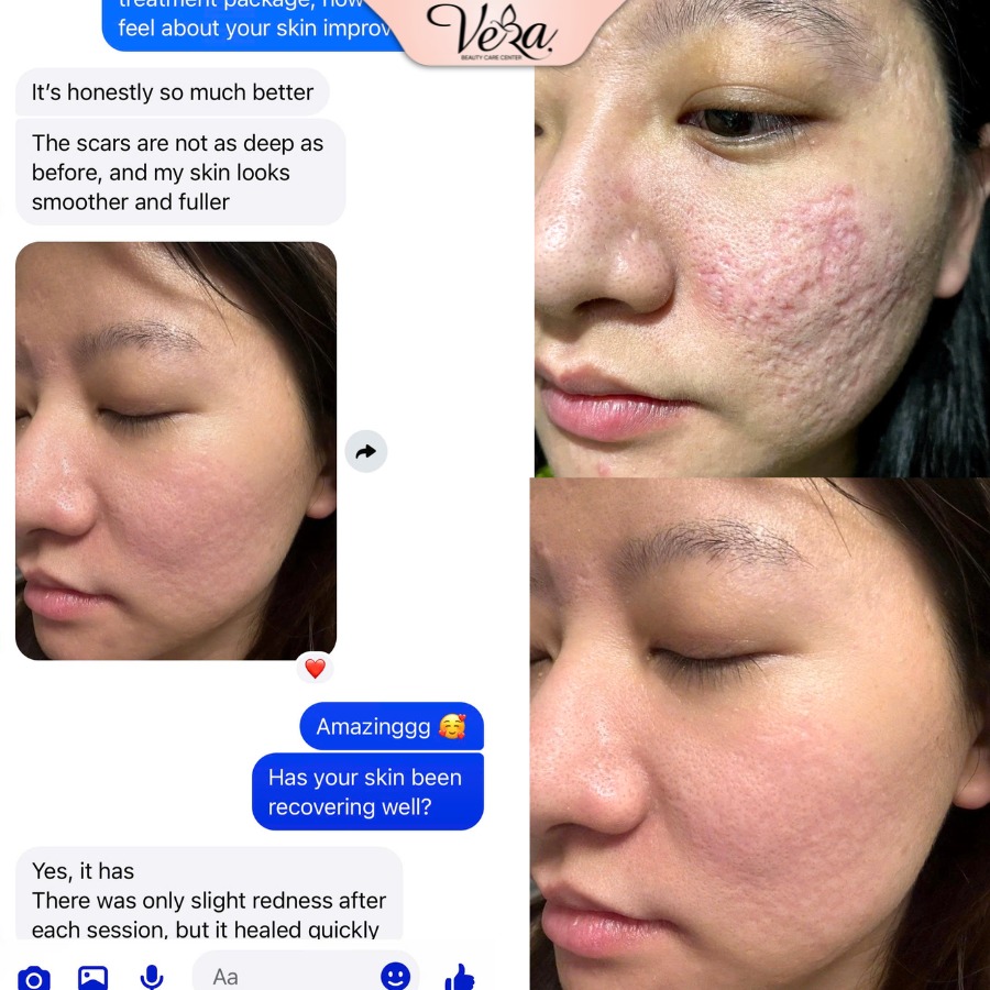 Vera Beauty Skincare Center Facebook ad: CUSTOMER FEEDBACK AFTER PITTED SCAR TREATMENT