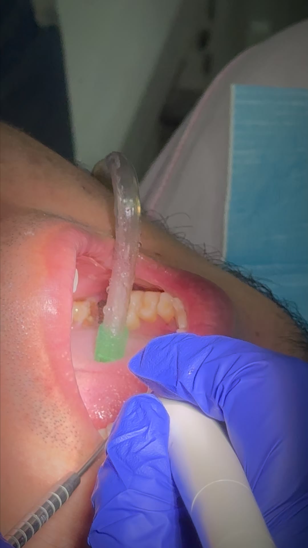 Zarene Dental Clinic - Bacoor Facebook ad: Fresh Breath Starts With Cleaner Teeth