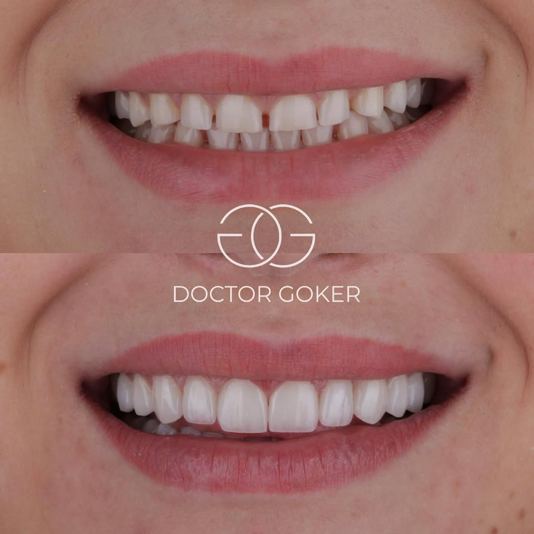 Gorkem Goker Facebook ad: 14 pieces of non-prep laminate veneers with gum…