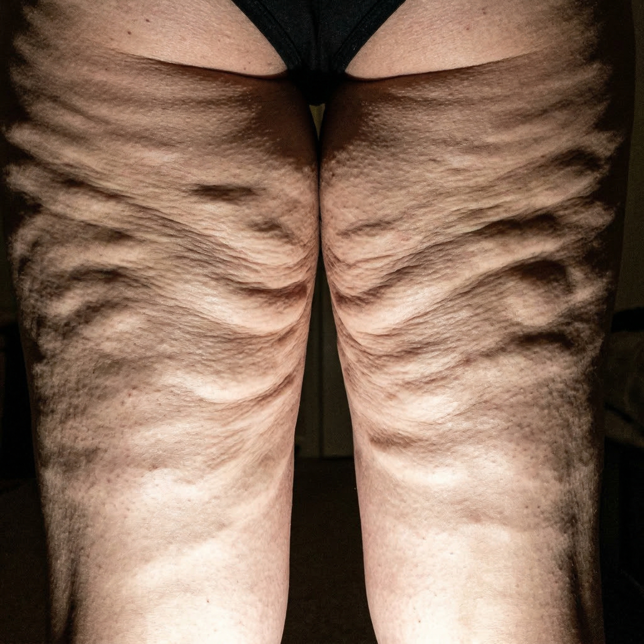 Susan Miller Facebook ad: I've Been Hiding My Legs For 3 Years.