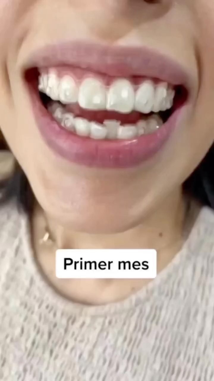 Centro Odontologico Bal Harbour Facebook ad: No esperes otro mes para alinear tu Sonrisa.
