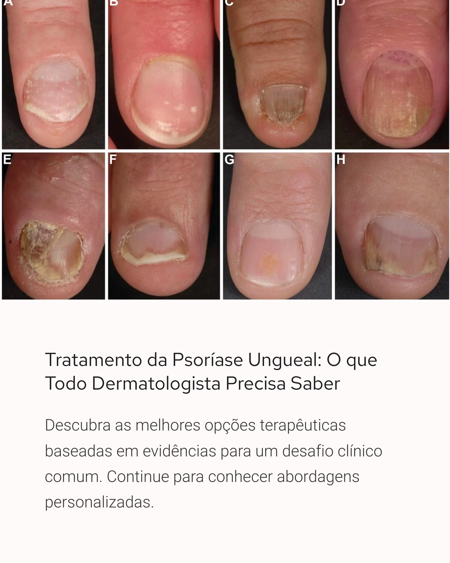 Pele Digital Facebook ad: COMPARTILHE ESTE CARROSSEL: Psoríase nas unhas?