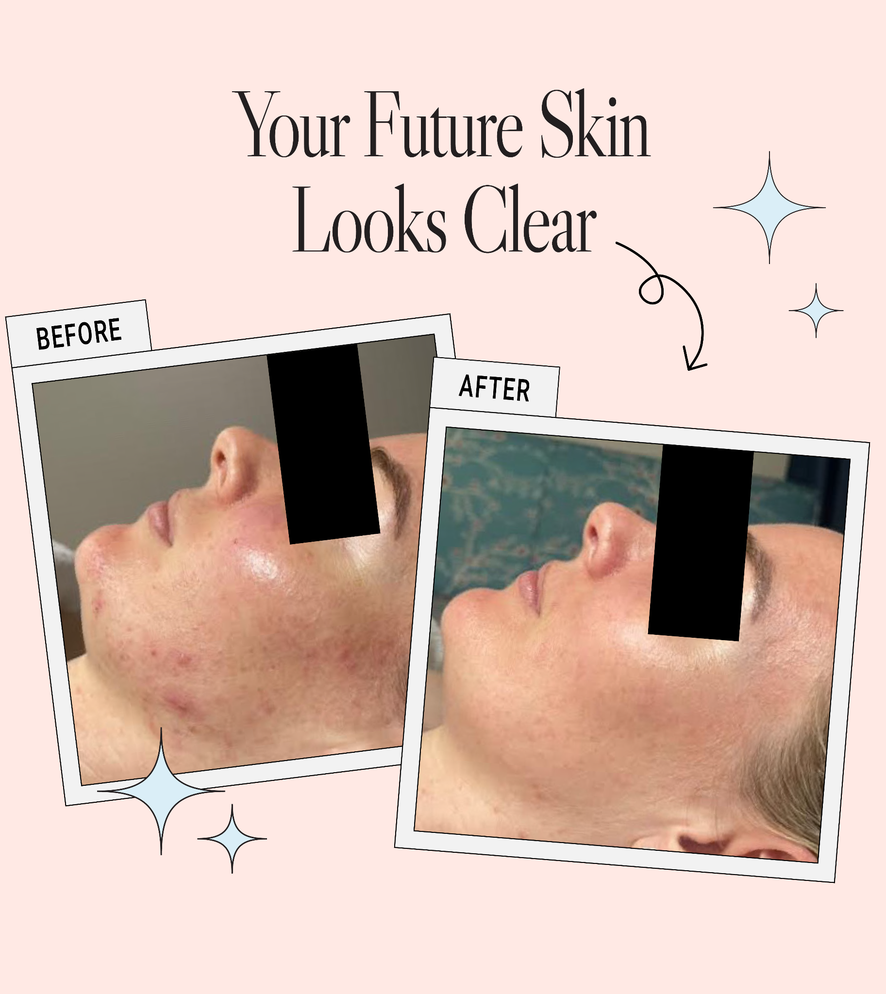 La Clinica For Skin & Body Facebook ad: After suddenly developing severe acne, Kelly was…