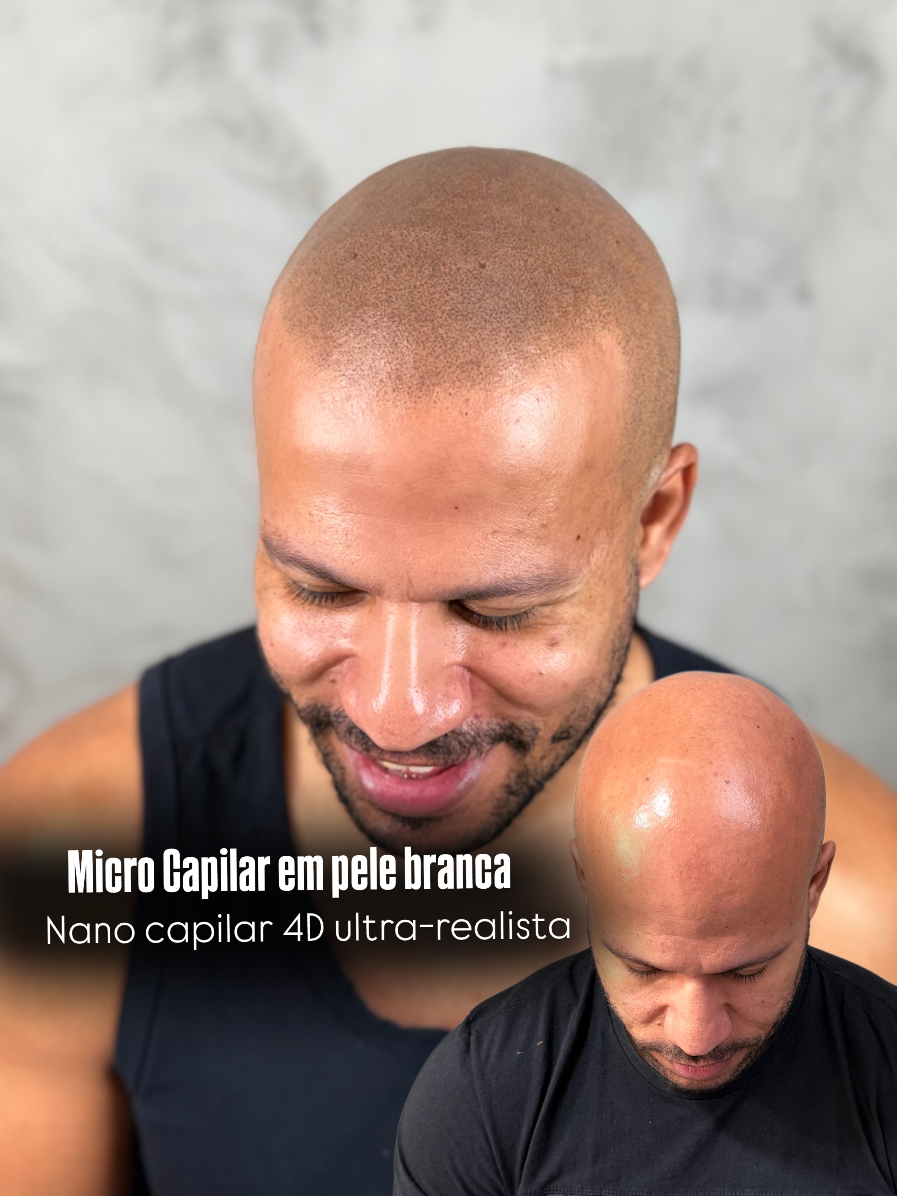 Geisa Silva - Micropigmentação Capilar Facebook ad: Micro Capilar em peles claras, fica bom?