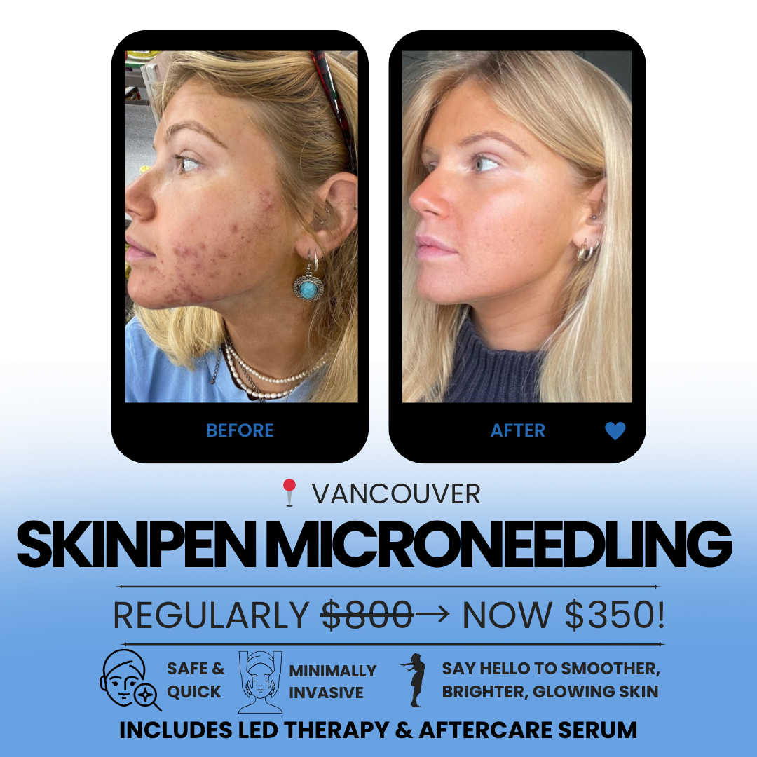 GraceMed Esthetics & Wellness Inc. Facebook ad: SkinPen Microneedling Session NOW FOR ONLY $350!
