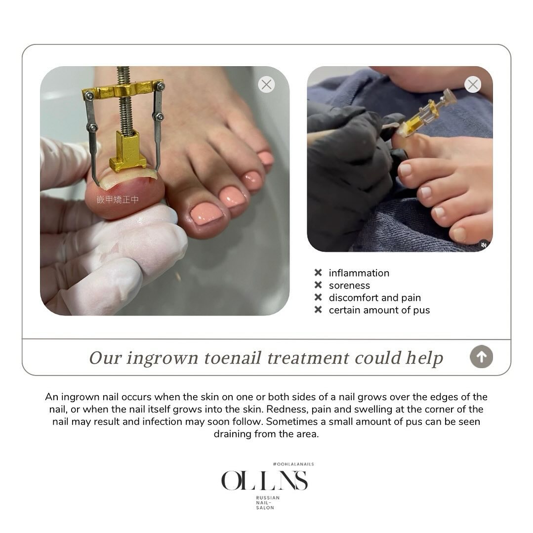 Ooh La La Nails - Wan Chai & LKF Facebook ad: Book us now for ingrown nail treatment