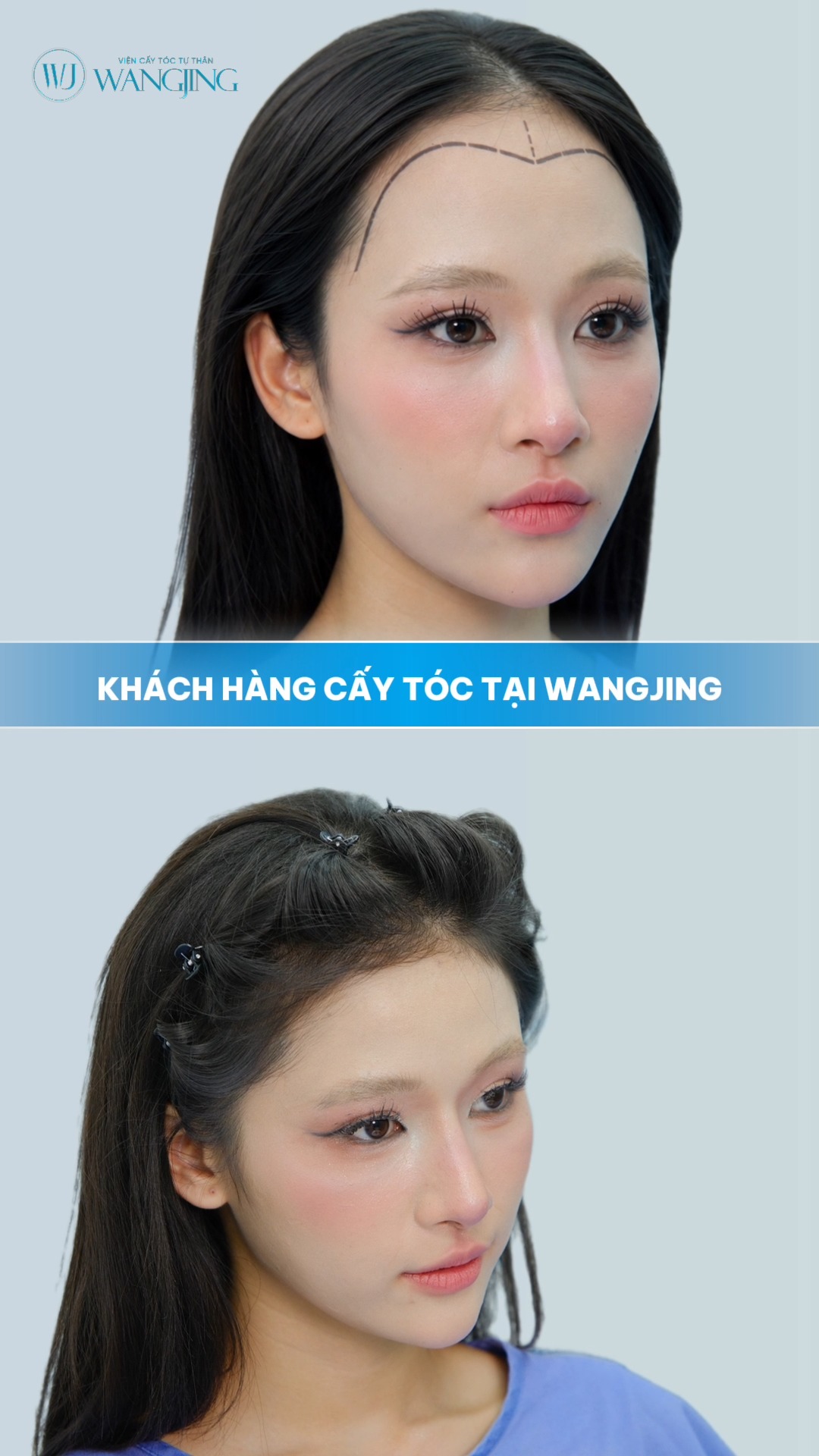 Viện Cấy Tóc Tự Thân WangJing DNA BioHair Facebook ad: Mỗi khách hàng tìm đến cấy tóc với…