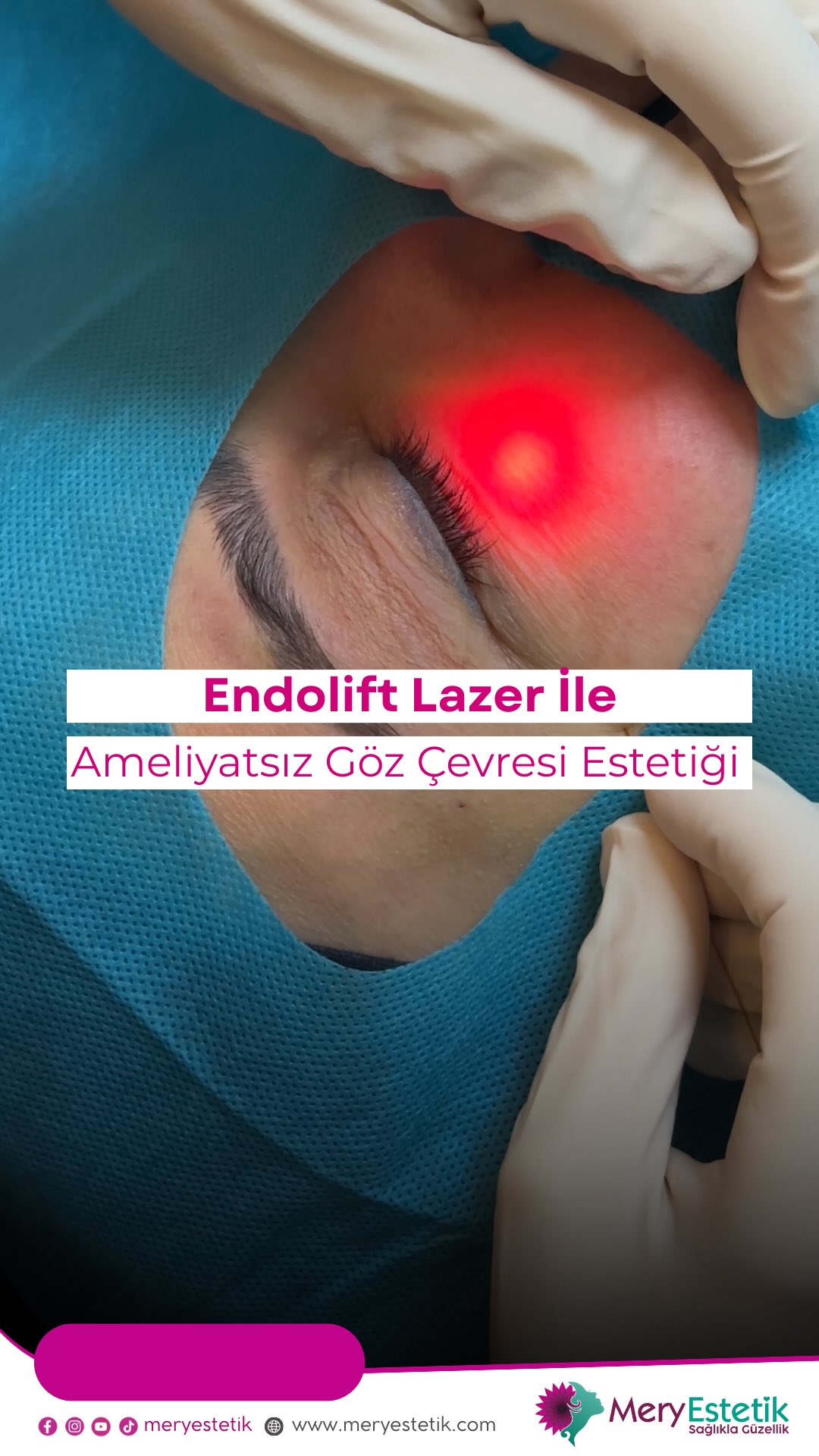 Mery Estetik Facebook ad: Göz Çevresi Endolift Lazer