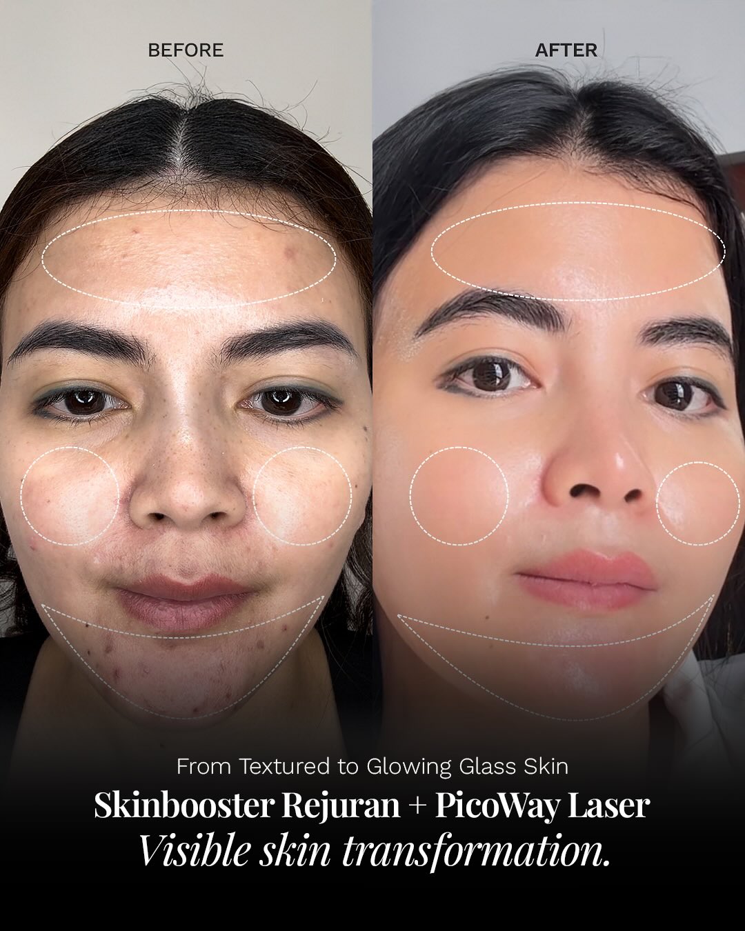 Elsheskinclinic Facebook ad: Kulit kusam, pori-pori besar, dan bekas jerawat sering…