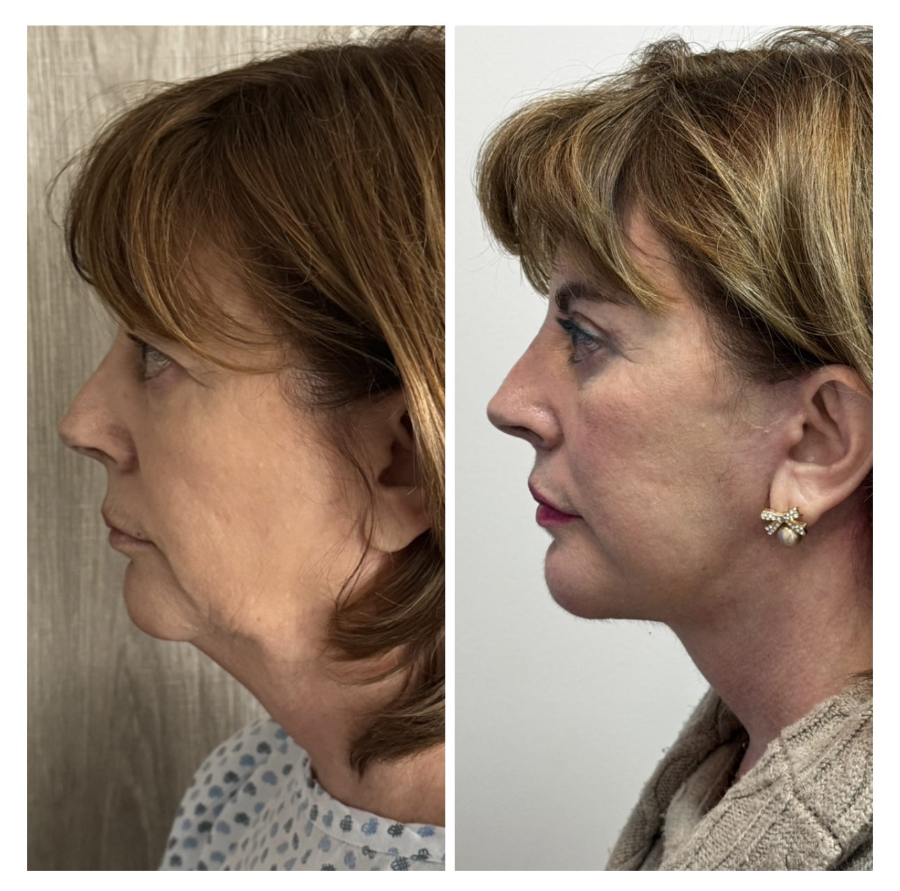 Dr. López Torres Facebook ad: Resultado a las 6 semanas de Full Facelift.