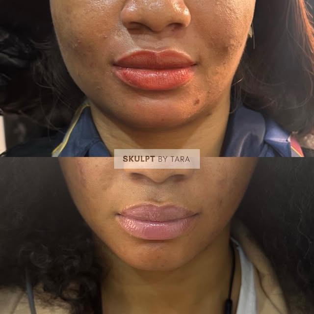 Skulptbytara Aesthetics Facebook ad: Jawline slimming using Botox