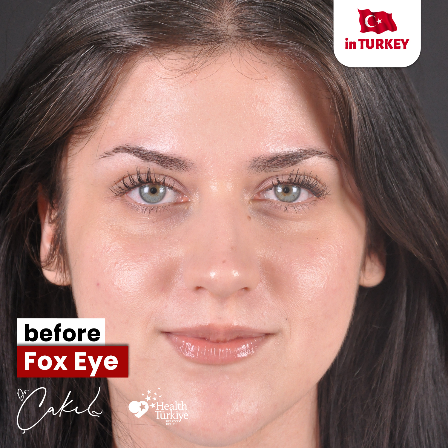 Op.Dr.Tolga Çakıl Facebook ad: The Eye Lift Everyone’s Talking About