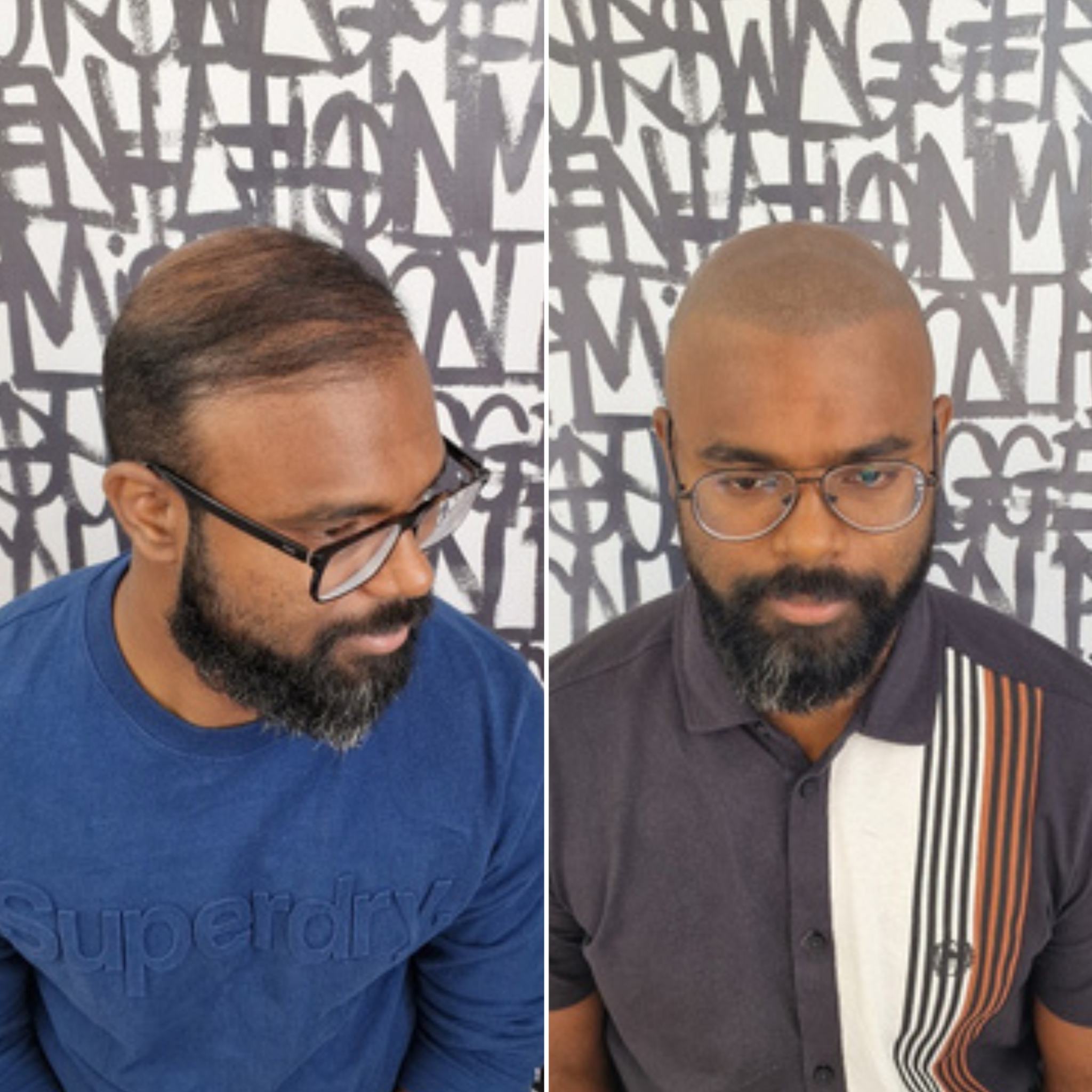 Scalp Micro UK Facebook ad: I got this done and it fixed my…