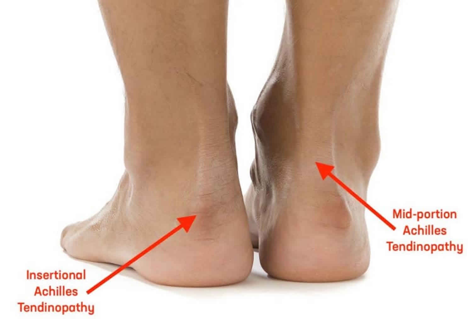 The Footcare Clinic Facebook ad: Achilles Pain Treatment