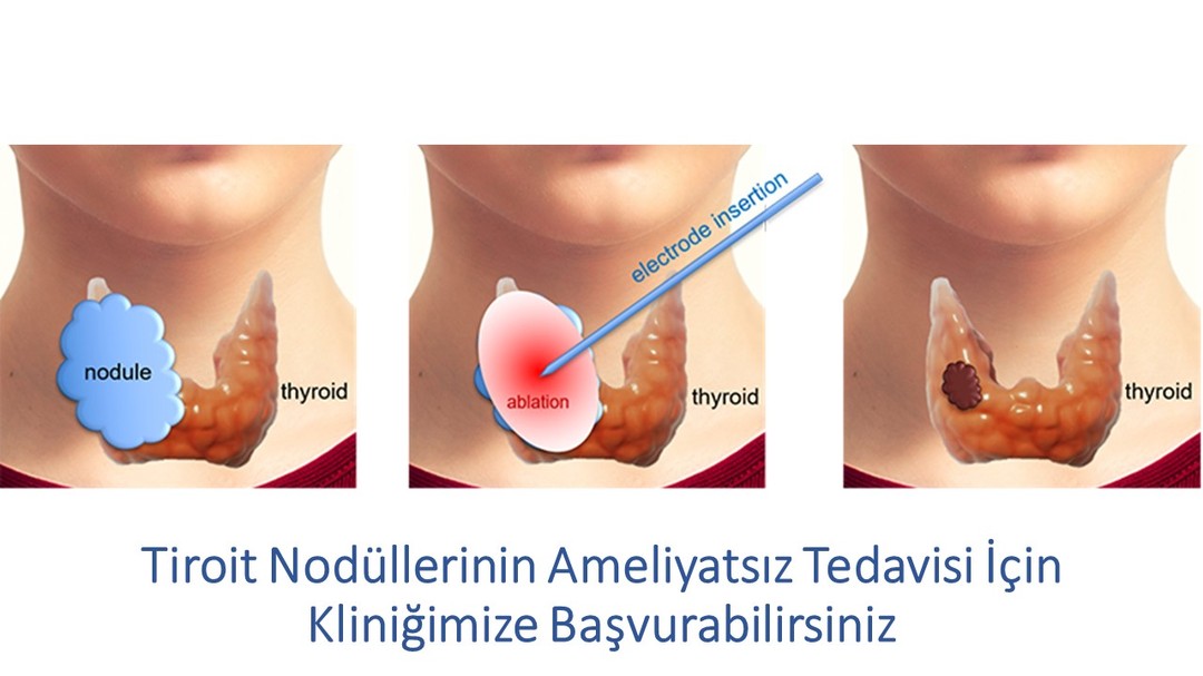 bodrum.endokrinoloji Facebook ad: Tel: 05358106300 & 02523193235
