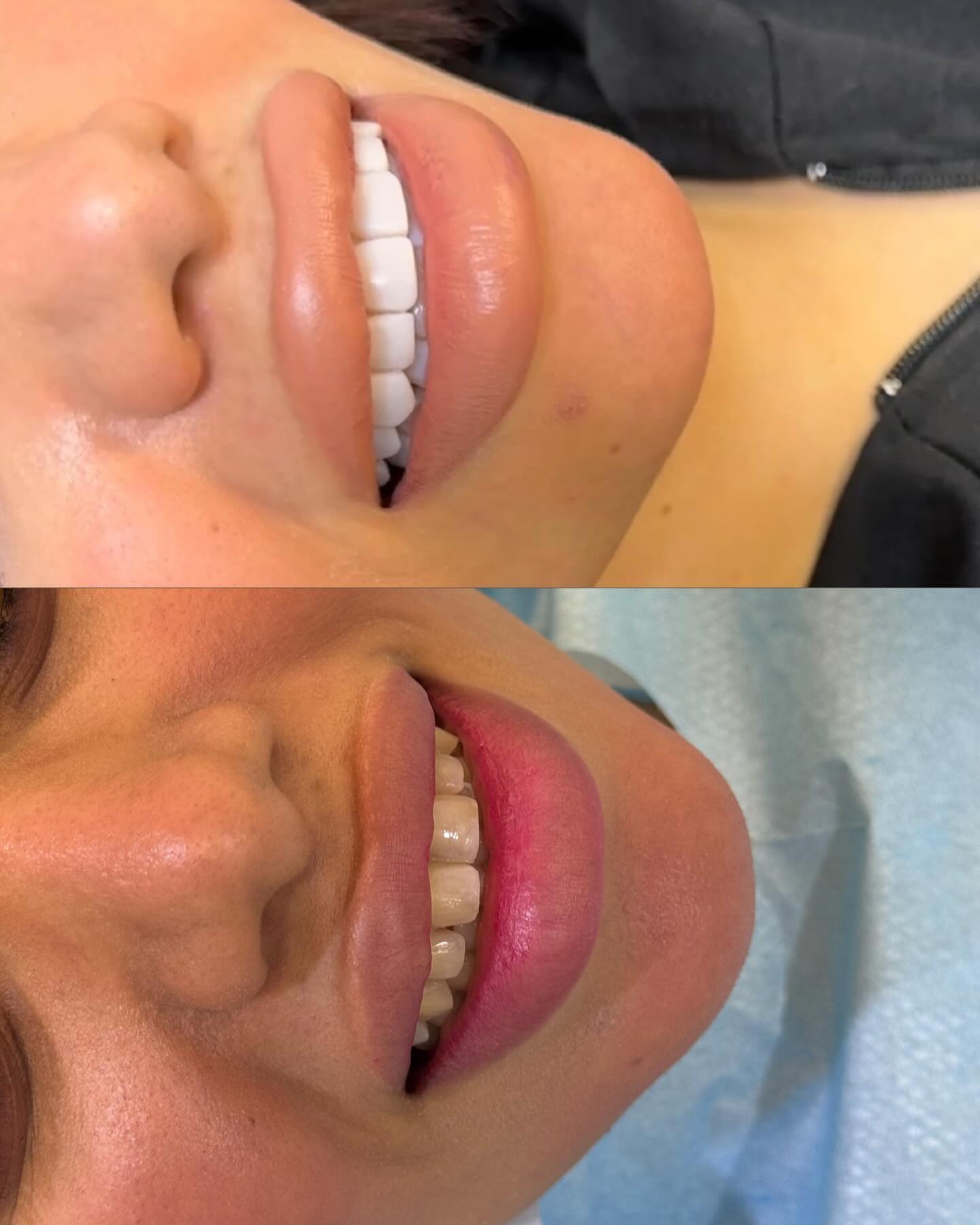 Dr Amaal Al Saffar Facebook ad: ابتسامة الدايركت فينير Direct composite veneers