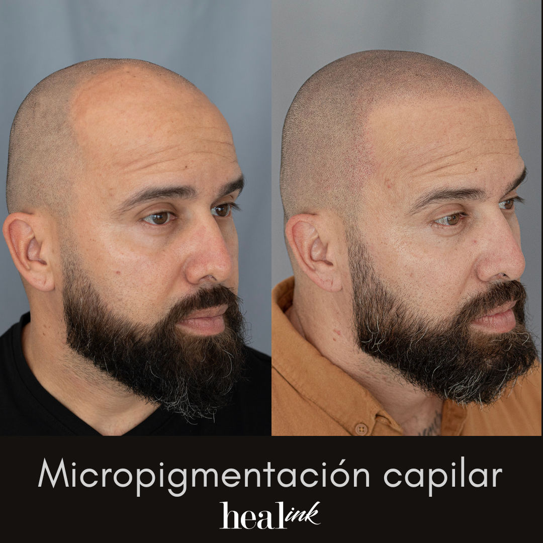 Heal-inkcr Facebook ad: ¡Transforme su apariencia con la micropigmentación capilar!