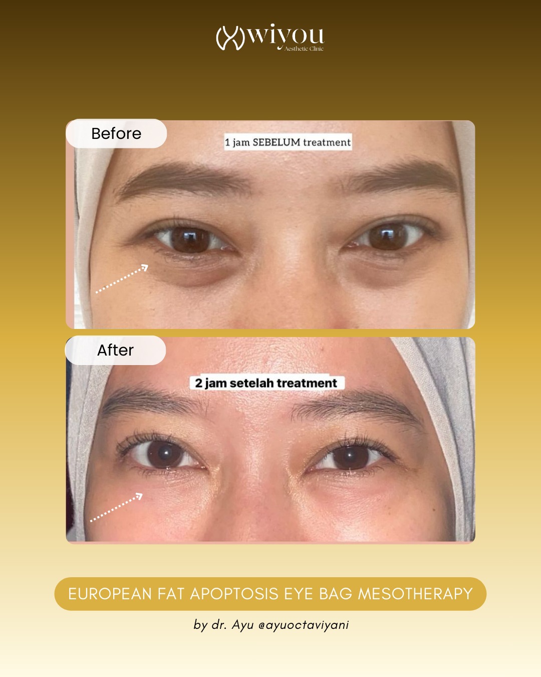 Wiyou Clinic Facebook ad: Mata panda bikin kamu keliatan capek terus?