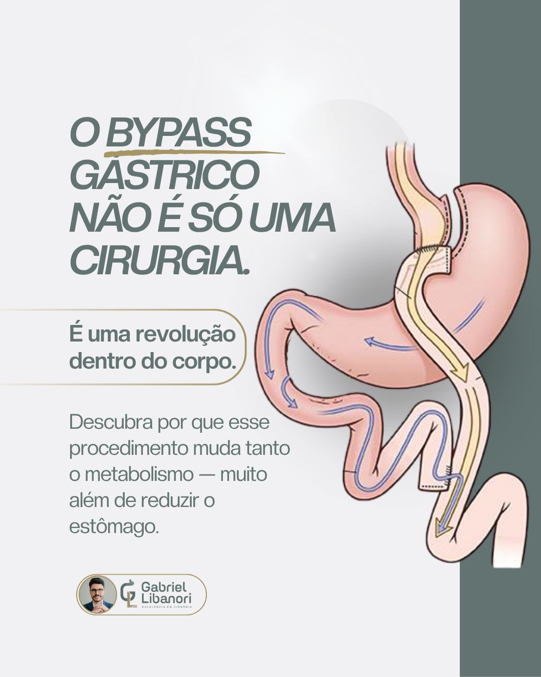 Dr. Gabriel Libanori Facebook ad: O bypass gástrico é uma das cirurgias mais…